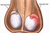 Đau nhức sưng tinh hoàn có thể gây vô sinh nam