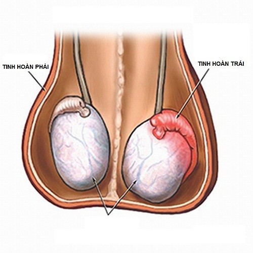 Đau nhức sưng tinh hoàn có thể gây vô sinh nam