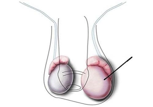 Tinh hoàn bên to bên bé – khi nào là biểu hiện bất thường?