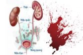 Chảy máu đường tiểu: Cảnh báo nguy cơ viêm đường tiết niệu nặng