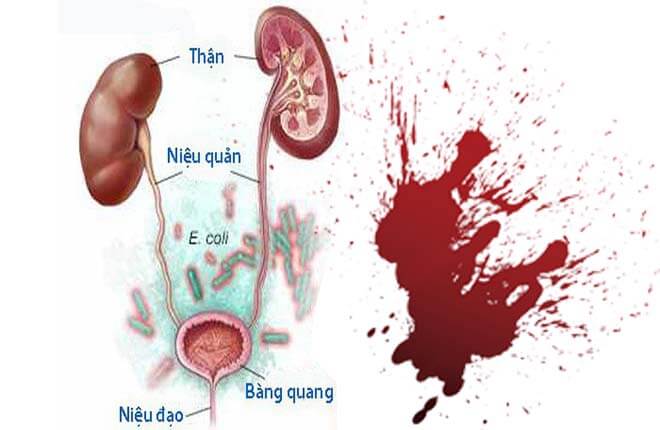 Chảy máu đường tiểu: Cảnh báo nguy cơ viêm đường tiết niệu nặng