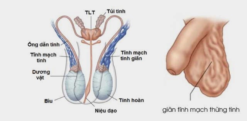 Giãn tĩnh mạch tinh có phải mổ không?