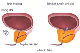 Các bệnh lý tiền liệt tuyến nam giới không được chủ quan