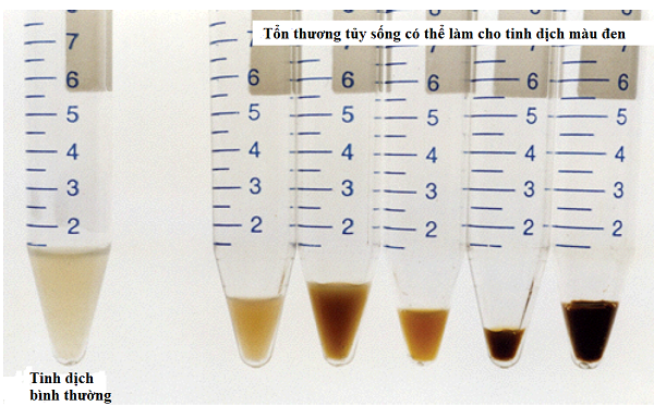Tinh trùng màu nâu xanh vàng cảnh báo những vấn đề gì?